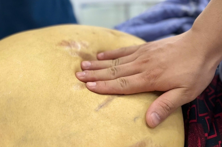 'Nát' gan, đối mặt ung thư vì thói quen nhiều người Việt vô tư làm 1 'Nát' gan, đối mặt ung thư vì thói quen nhiều người Việt vô tư làm nat gan doi mat ung thu vi thoi quen nhieu nguoi viet vo tu lam
